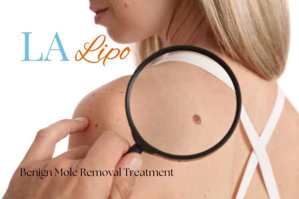Woman having her inspection of blemish before mole removal Milngavie