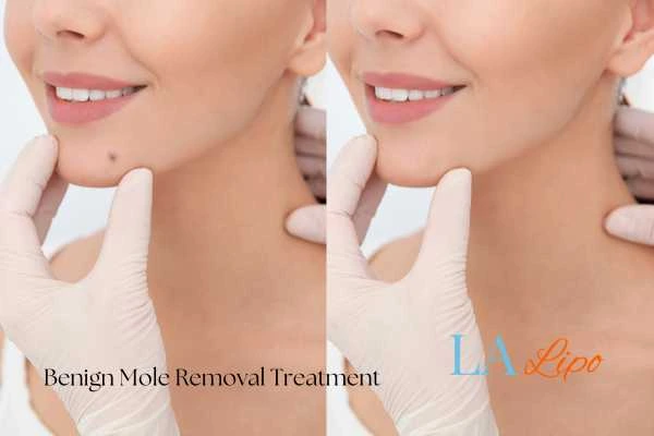 Before and after mole removal Milngavie treatment