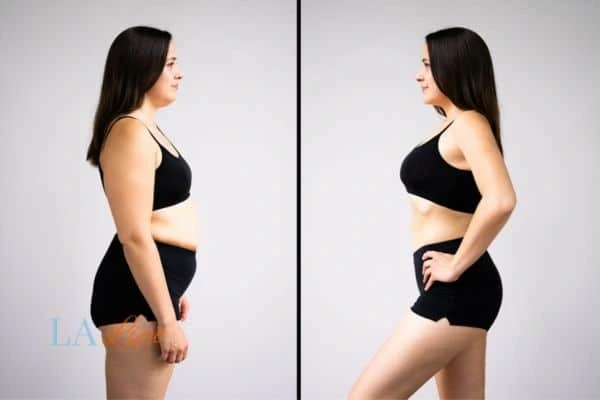 image of woman before and after results of LA-EMS Body Sculpting Milngavie to help treat Diastasis recti
