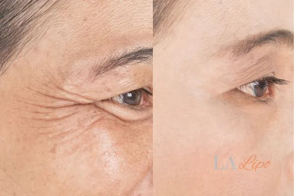 Before and after results of woman - HI-fu wrinkles reduction treatment Milngavie