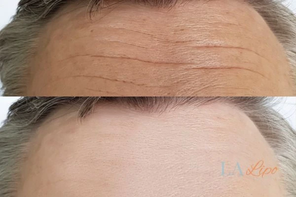 results of HIFU Milngavie on mans forehead to help reduce lines and wrinkles