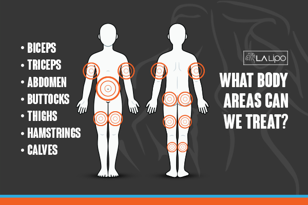Graphic to show areas you can have LA-EMS Body Sculpting Milngavie treatment.