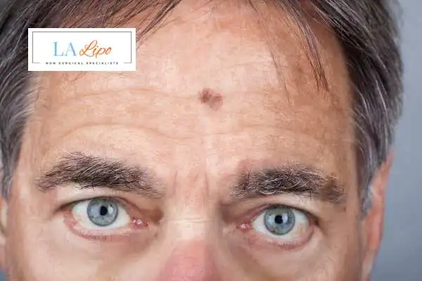 Solar Lentigo Removal Milngavie image of man with mark on his forehead