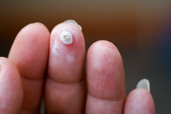 wart on person finger - cryotherapy to treat from LA LIPO Milngavie