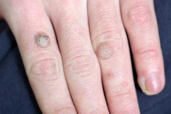 photo of warts on person hand - see wart removal Milngavie from LA LIPO