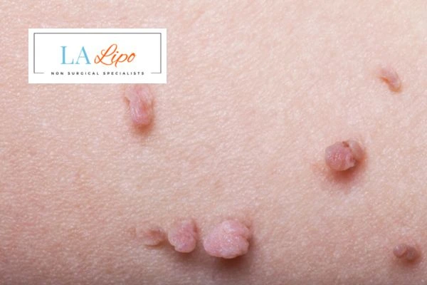 Does cryopen skin tag removal Milngavie hurt? Find out now call our team today!