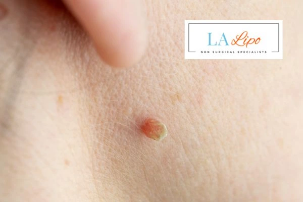 Book skin tag removal Milngavie today speak to our team now!