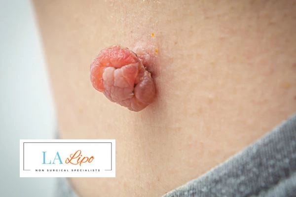 Interested in skin tag removal Milngavie ? Concerned about the pain? Find out more today!