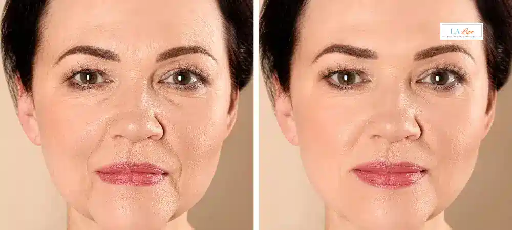How Long Does It Take to See Results and How Long Do They Last Milngavie ?