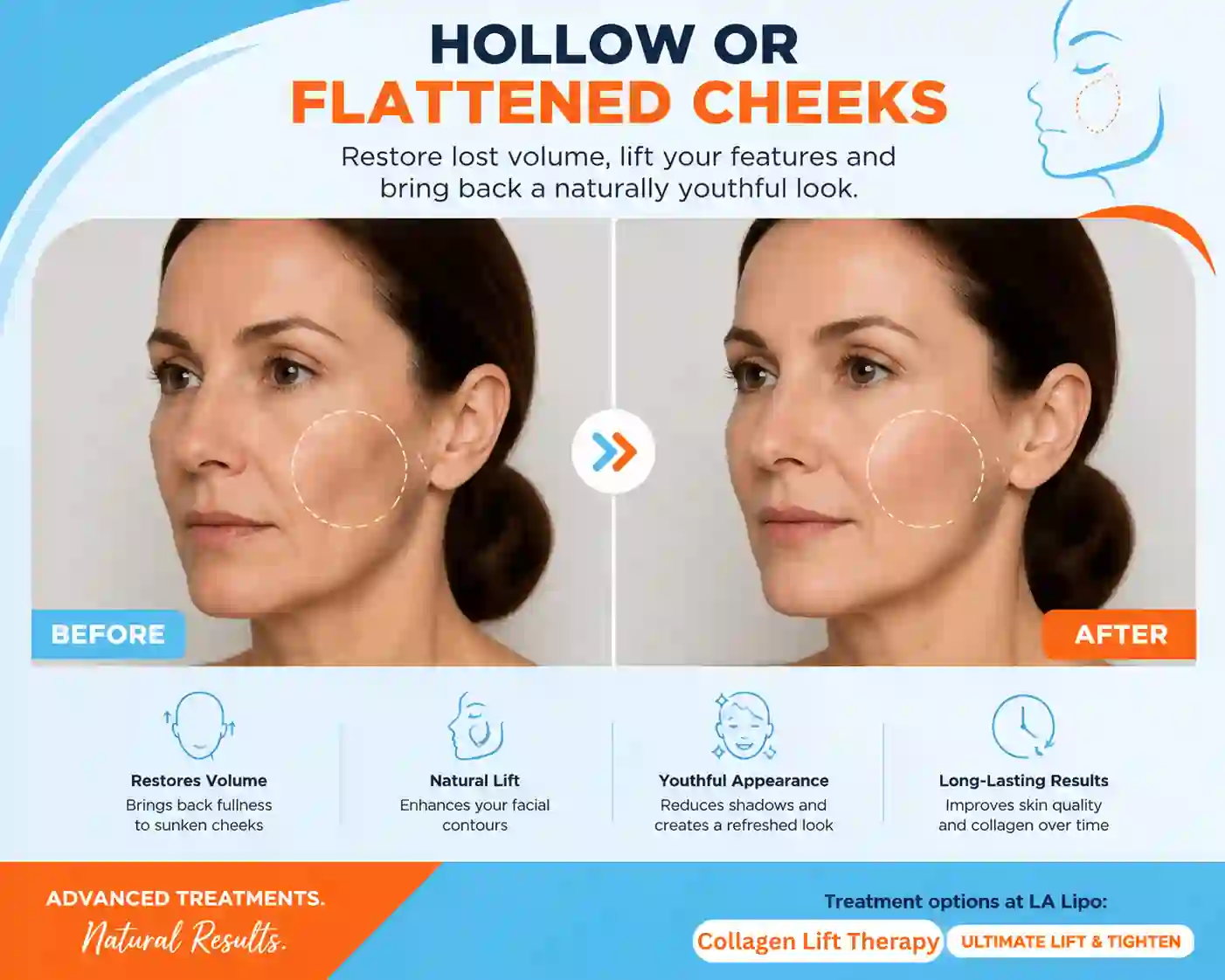 Sign #4: Hollow or Flattened Cheeks Milngavie